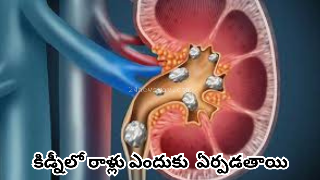 Why do kidney stones form?